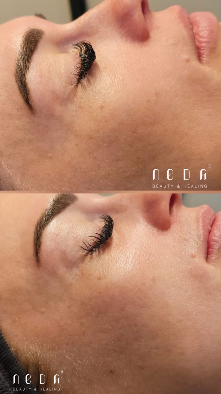 PRX Plus result, before and after