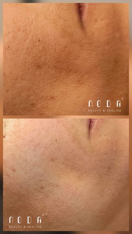 PRX Plus result, before and after