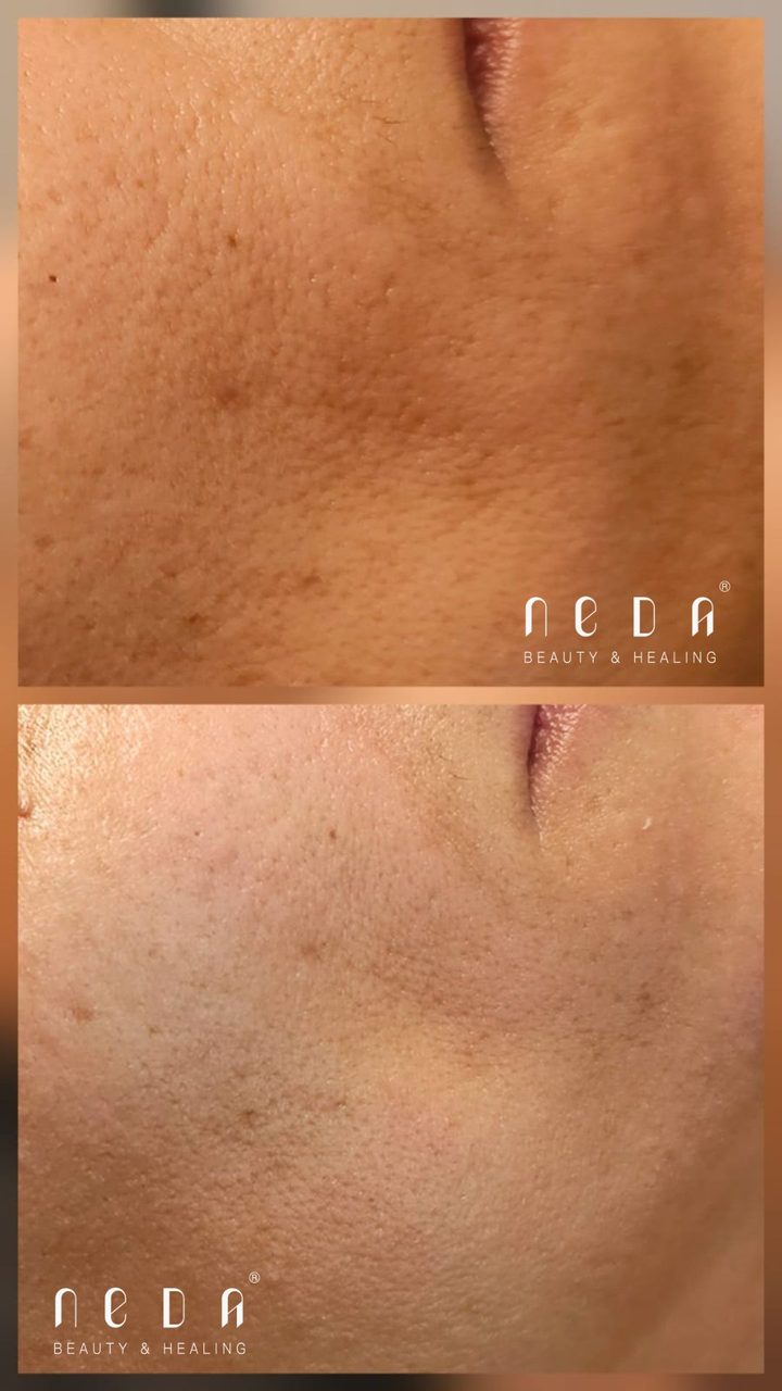 PRX Plus result, before and after