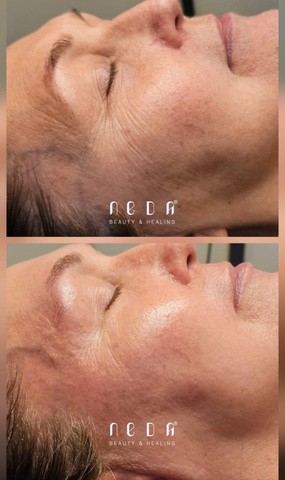PRX Plus result, before and after