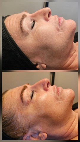 PRX Plus result, before and after