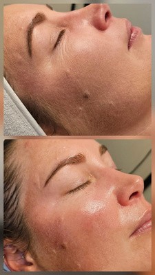 PRX Plus result, before and after