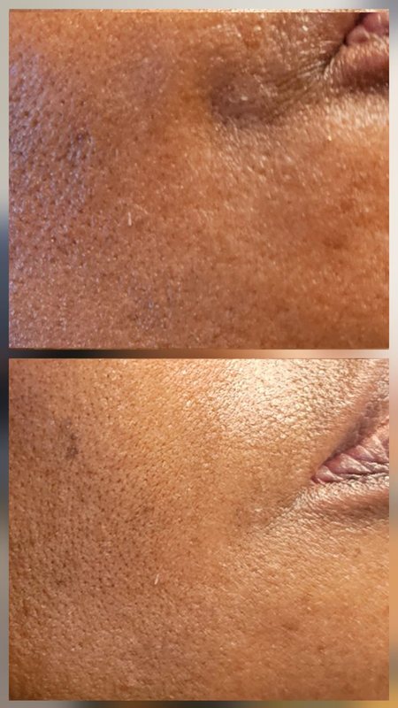 PRX Plus result, before and after