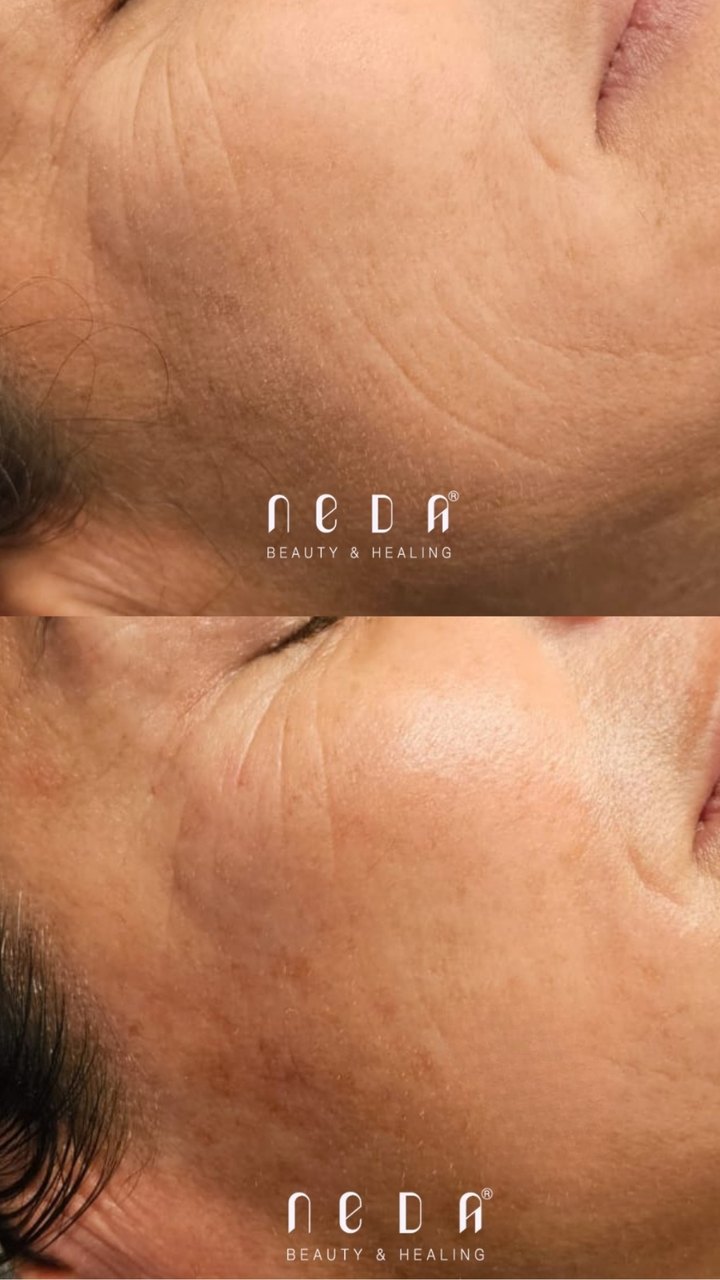 PRX Plus result, before and after