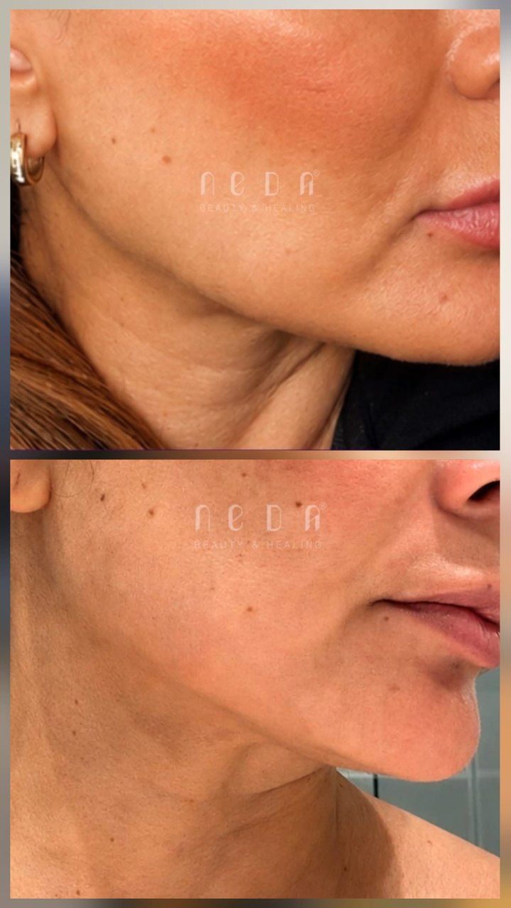 PRX Plus result, before and after